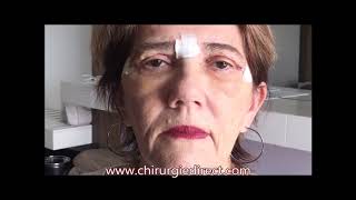 Chirurgie esthétique Tunisie La blépharoplastie ou chirurgie des paupières [upl. by Idet]