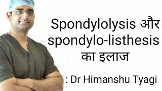 spondylolysis spondylolisthesis and treatment [upl. by Helprin]