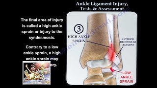 Ankle Ligament Injury evaluation and tests  Everything You Need To Know  Dr Nabil Ebraheim [upl. by Rhoads]