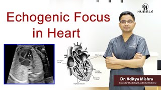 Echogenic Focus in Heart [upl. by Bohlen]