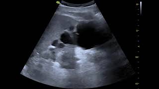 polycystic kidney disease on ultrasound [upl. by Hammad487]