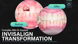 SO MUCH DAMAGE COMPLEX Bite and Pontic  Impossible Transformation Solved with Invisalign Ep6 [upl. by Morrison]