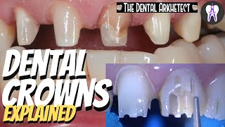 DENTAL CROWNS Patients Request to Make Her Teeth Uniform 4k c34 dentist [upl. by Annaili]