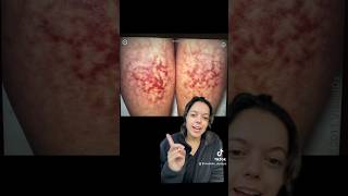 Erythema Ab Igne Beware skincare dermatology spaceheaters [upl. by Trevah613]