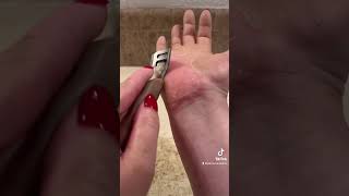 Shaving my nondominant hand  epidermolytic palmoplantar keratoderma  Feb 26 2023 [upl. by Ahsieym661]