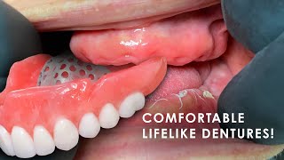 How to Create Comfortable Lifelike Dentures [upl. by Oner]