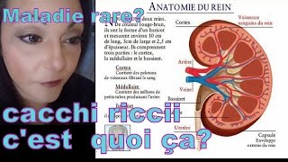 Cacchi Ricci ma maladie rare et orpheline  crise de colique néphrétique [upl. by Allie]