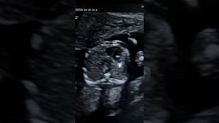 Echogenic intracardiac focus or EIF ultrasound  anomaly scan sonography  pregnancy ardms  down [upl. by Ativad]