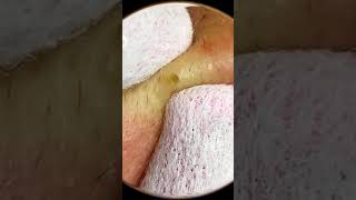 Removing Acne acnes skincare skintreatment [upl. by Eleon774]