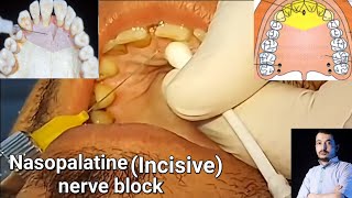 Local Anesthesia Nasopalatine Nerve block technique Maxillary anesthesia Techniques dentistry [upl. by Jolee]