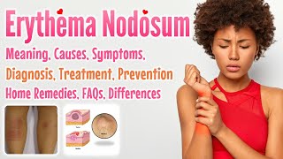 Erythema Nodosum meaning causes symptoms diagnosis treatment prevention home remedies FAQs [upl. by Doty132]