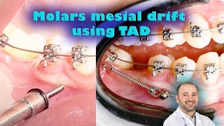 Dental implant or spaces closure by braces using tads miniimplant for molar mesial drifting [upl. by Bertelli682]