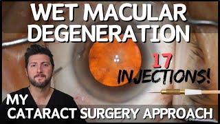 Cataract Surgery for Wet Macular Degeneration  Things to Consider [upl. by Karlise]