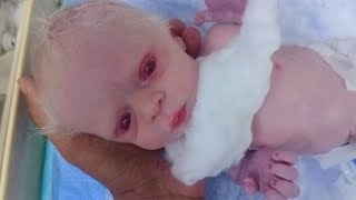 New born baby very small and preterm and low birth weight baby albino baby these baby came very rare [upl. by Marillin]