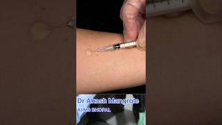 Mantoux Test  Tuberculin Skin Test doctor aiims neet academic mbbsmotivation [upl. by Enileuqkcaj]