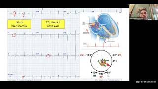 Arrhythmia Lectures Bradycardia  By Dr Mohamed Ibrahim [upl. by Attwood373]