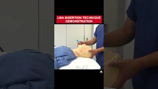 LMA Insertion Technique Demonstration  shorts airway LMA [upl. by Xyla]