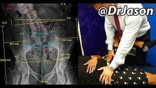 Dr Jason  DETROIT MAN WITH SCOLIOSIS FLAT FEET BUNIONS BACK SPASMS COMPLEX CASE Part 2 [upl. by Ylrebmi]