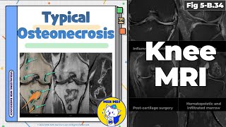 Fig 5B34 Typical Osteonecrosis [upl. by Rumilly]