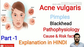 Acne vulgaris  Acne  Pimple  blackhead Whitehead  pathophysiology  cause and risk factors [upl. by Knah]