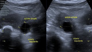 RETRASO MENSTRUAL PRUEBA DE EMBARAZO NEGATIVA USG REPORTA QUISTE OVÁRICO [upl. by Turnbull]