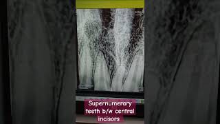 supernumerary teeth bw central incisors dentalcafe4331 [upl. by Burger]