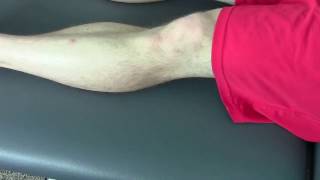 Knee Pain Hyperextension Treatemt Part 1 [upl. by Ot]