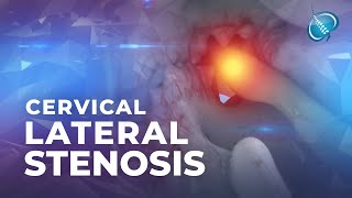 What is Cervical Lateral Stenosis  Foraminal Stenosis [upl. by Annodam494]