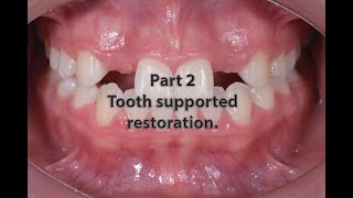 management of missed lateral tooth supported restoration [upl. by Eikin451]