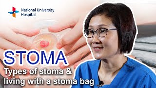 Stoma – Types of Stoma and Living with a Stoma Bag [upl. by Anohs892]