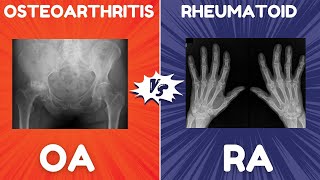 Osteoarthritis OA vs Rheumatoid Arthritis RA  Radiographic Features [upl. by Aleron836]