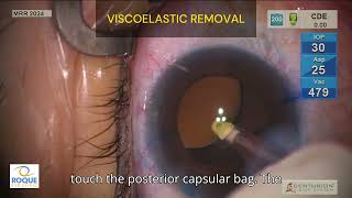 Viscoelastic removal [upl. by Yovonnda]