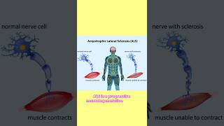 Amyotrophic lateral sclerosis neuroscience amyotrophiclateralsclerosis brainscience [upl. by Nehtanhoj]