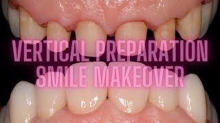 VERTICAL PREPARATION full case Zirconia crowns [upl. by Haizek]