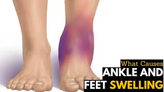 What Causes Ankles amp Feet Swelling  Diagnosis amp Treatment [upl. by Aerdnahs855]