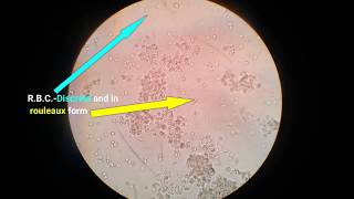 Stool analysisLab diagnosis of dysentery bacillary dysentery [upl. by Wilow]