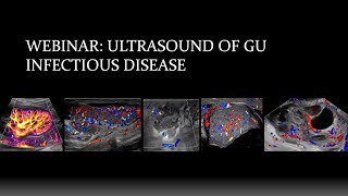 Webinar Ultrasound of Genitourinary Infectious Disease [upl. by Claudy]