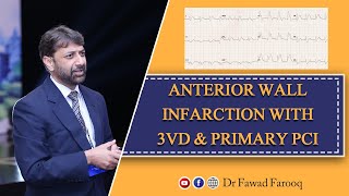 Anterior wall Infarction with 3VD and Primary PCIEnglish DrFawad Farooq [upl. by Aicnilav]