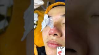 Inflamed Acne on Nose shorts pimple acne acneking [upl. by Sholom698]