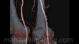 Lower Limb CT Angiography [upl. by Gilford]