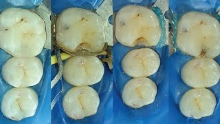 Class 2 Cavity preparation for composite restoration [upl. by Ayerf]