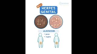 Herpes Genital [upl. by Monsour]