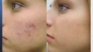 Acne Treatment with Fotona Laser [upl. by Reahard6]