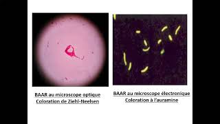 06Tuberculose extrapulmonaire TEP Pr Yahaoui Beni Messousse  Pneumo [upl. by Berkin821]