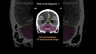 Falx and tentorium CT braincoronal image CT Brain Anatomy Meninges Quiz 14radiologychannel007 [upl. by Inalaehon]