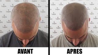 Jai testé la tricopigmentation effet rasé après 2 greffes de cheveux DHI [upl. by Akeyla]