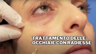 Trattamento delle Occhiaie con Radiesse Dr F Bernardini [upl. by Stier874]