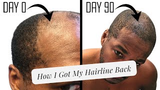 Microneedling for a Receding Hairline  Unedited Progress Pics [upl. by Quinton897]