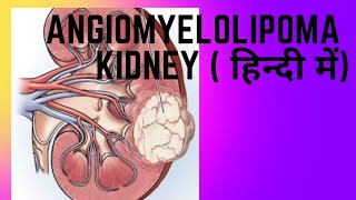 Angiomyelolipoma AML of kidney  एंजियोमायोलिपोमा एएमएल किडनी [upl. by Aloise373]