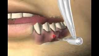 Dental Cyst  Cystostomy [upl. by Par297]